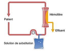 Hemofiltración venovenosa continua predilucional (CVVH predilucional)