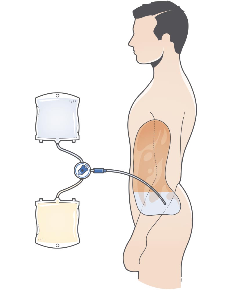 Diagrama de la diálisis peritoneal